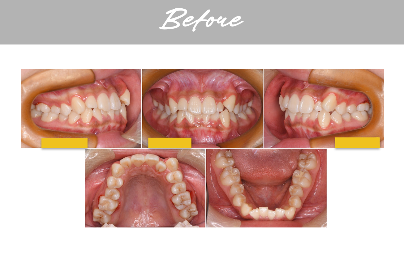 矯正治療前（Before）の歯並びの様子