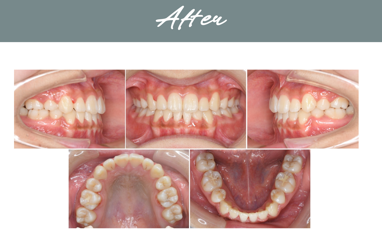 矯正治療後（After）の整った歯並び